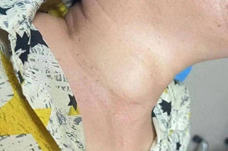 脖子长瘤跟头一样大,一个脖子跟头有多少厘米高?