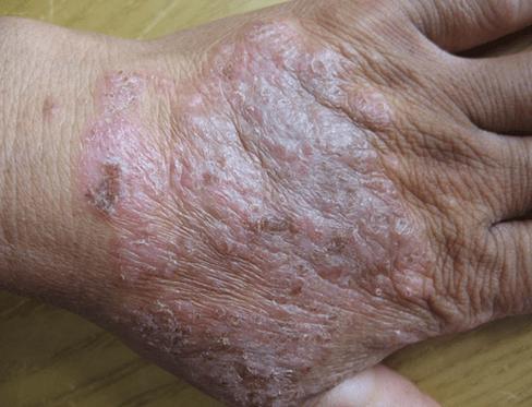 最疼皮肤病高发期,皮肤病的高发期