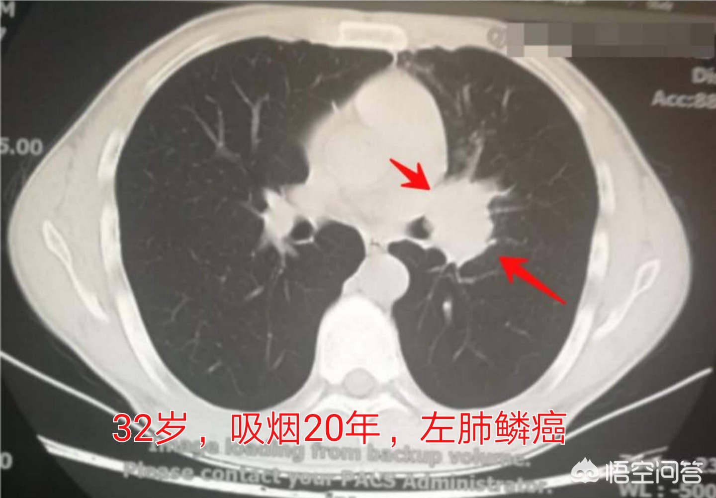 不抽烟的女性得肺癌,为什么有些不吸烟的女性会患肺癌？