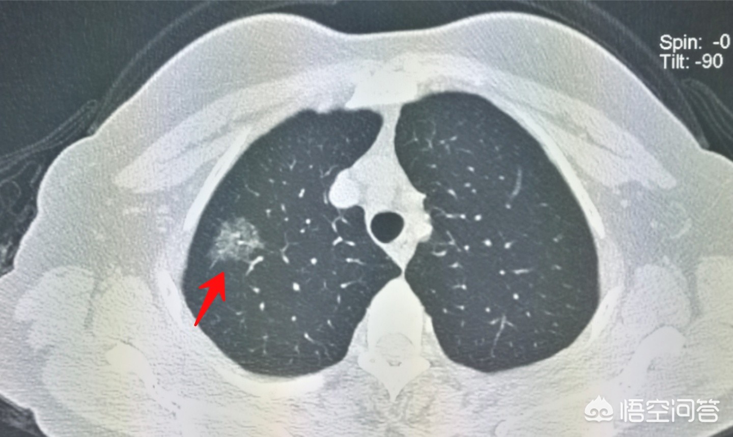 不抽烟的女性得肺癌,即使不抽烟不喝酒,女性得肺癌的原因有哪些呢? 不抽烟的女性得肺癌,即使不抽烟不喝酒,女性得肺癌的原因有哪些呢?