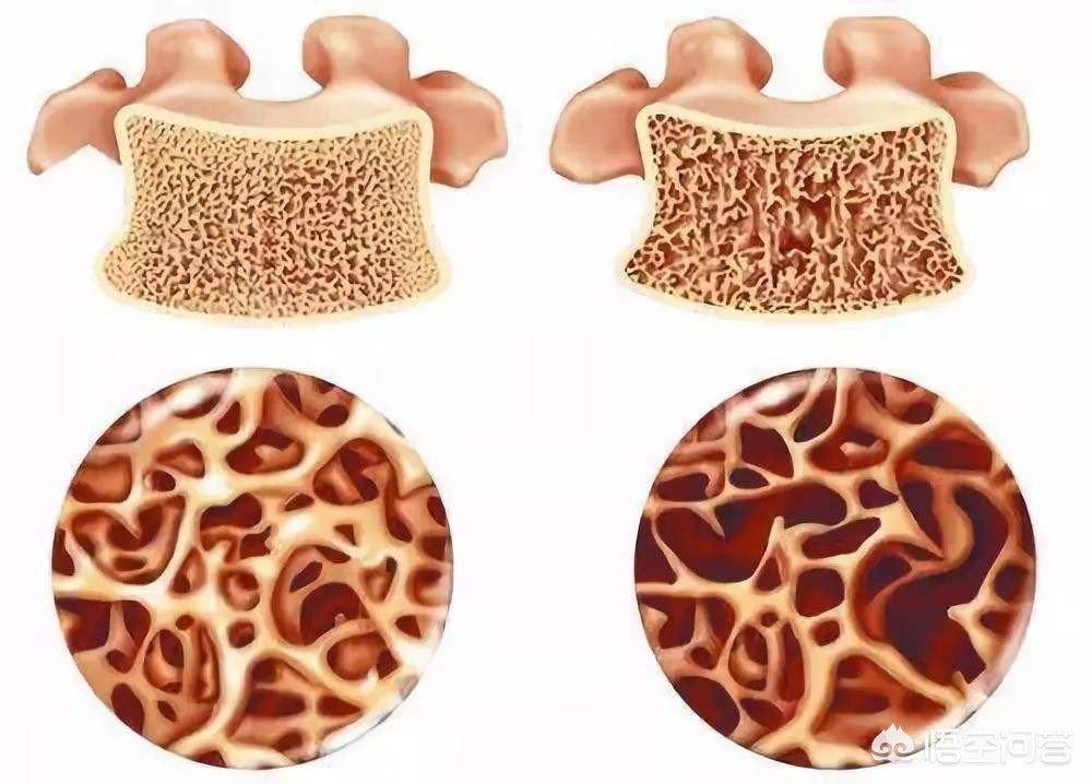 近8成女性骨质疏松,女性骨质疏松比例