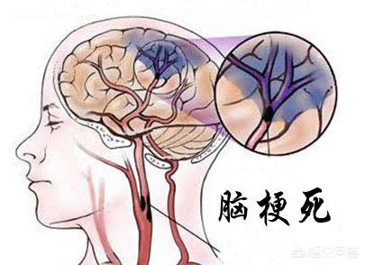 抢手机玩时突发脑梗,如何看待女孩20小时玩手机患脑梗塞，医院立即连夜急救？