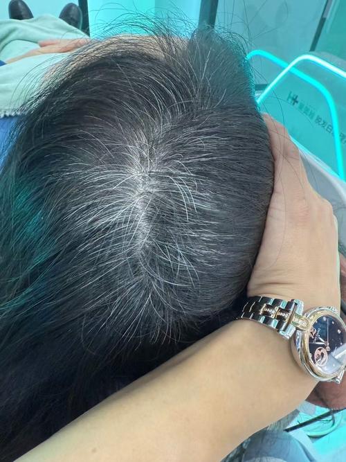 34岁妈妈满头白发,35岁年轻人长了几十根白头发,能通过饮食和休息让白发变黑吗?