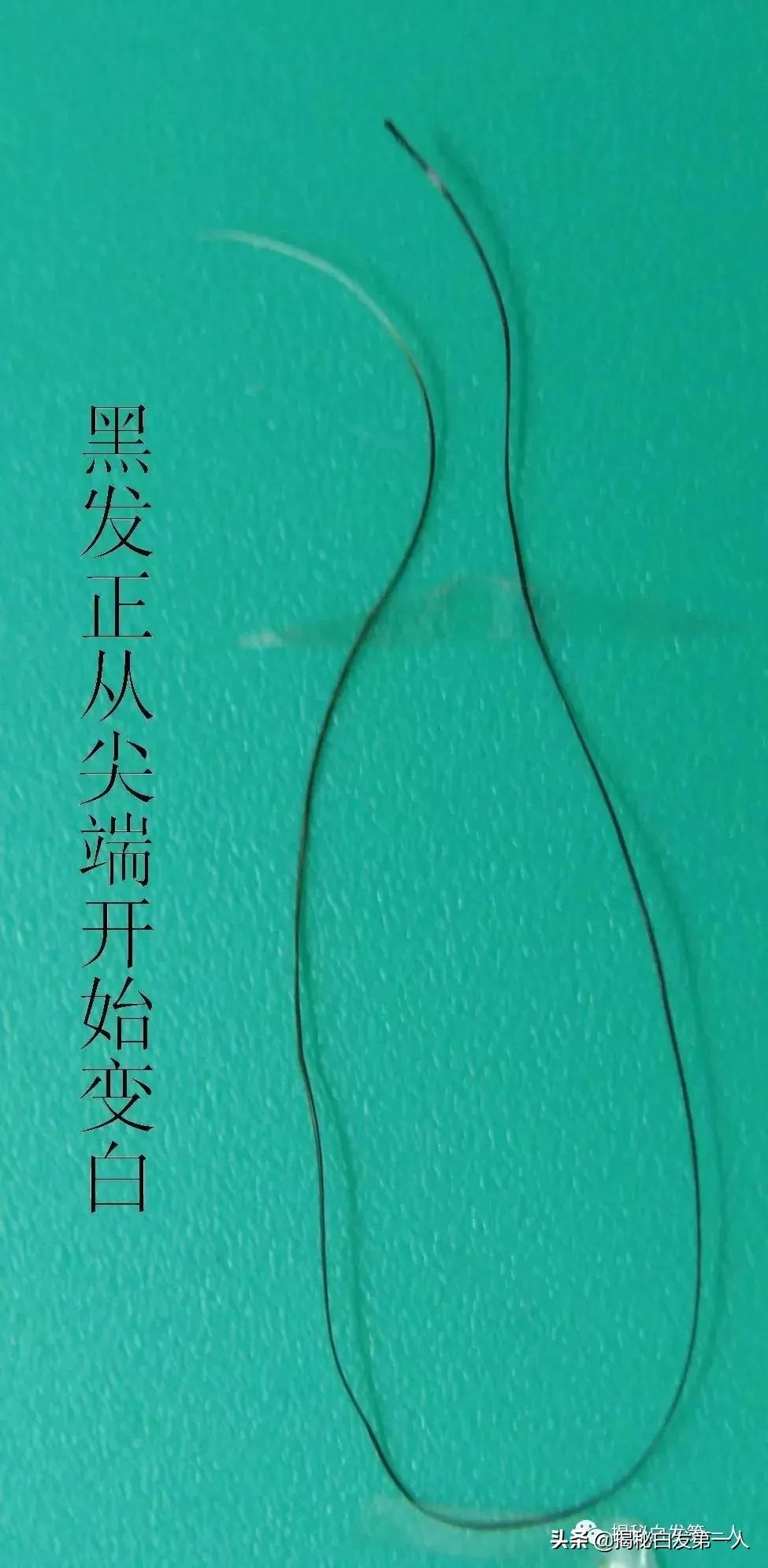 34岁妈妈满头白发,35岁年轻人长了几十根白头发,能通过饮食和休息让白发变黑吗? 34岁妈妈满头白发,35岁年轻人长了几十根白头发,能通过饮食和休息让白发变黑吗?