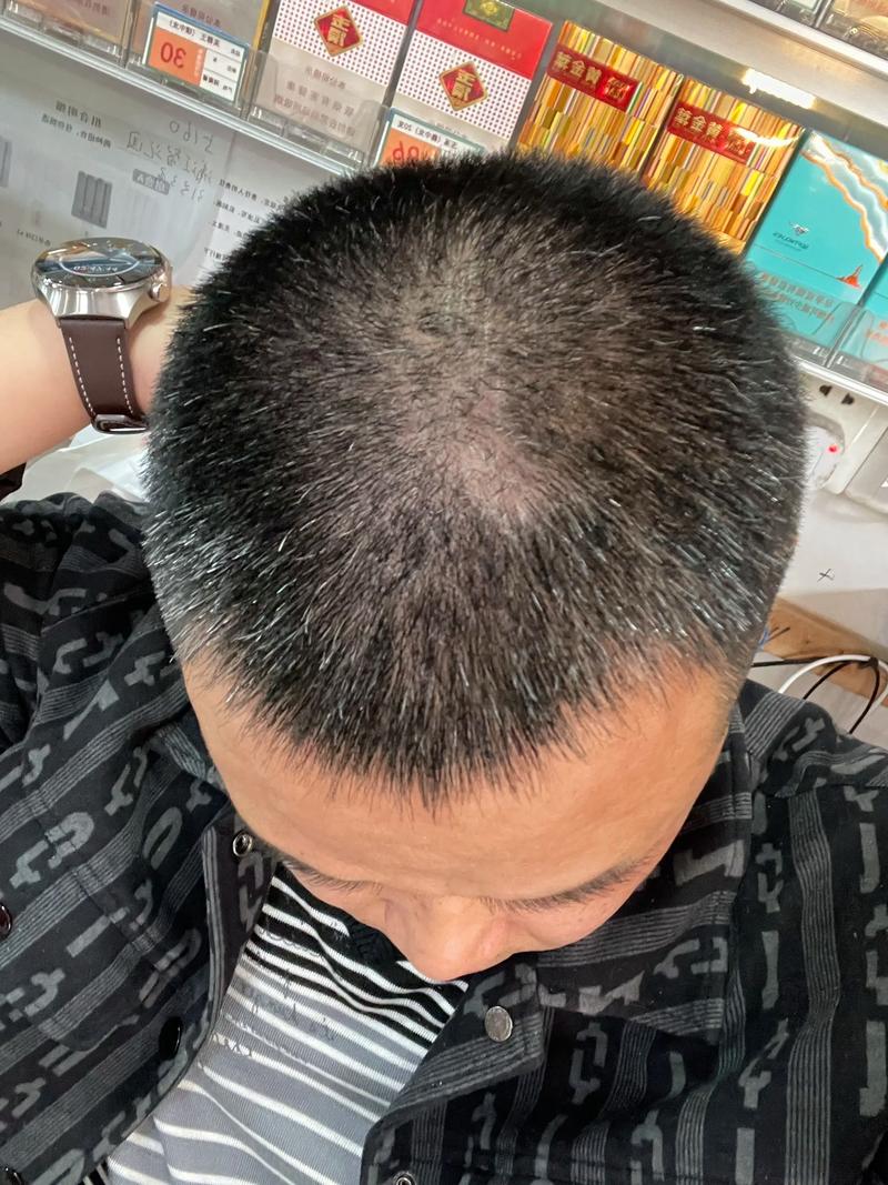 34岁妈妈满头白发,34岁,最近两年白发有增多的现象,多在头顶和两鬓,洗头头发也掉的厉害,怎么办?