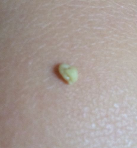 喉咙痛咽喉长满雪花,喉咙疼带血还有臭臭的小颗粒