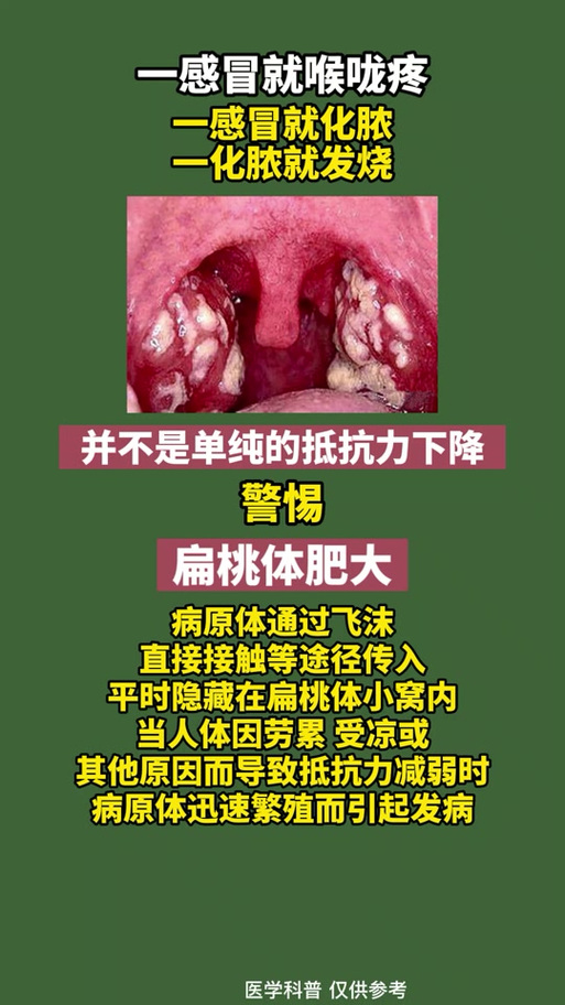 喉咙痛咽喉长满雪花,喉咙痛咽喉长满雪花状疙瘩