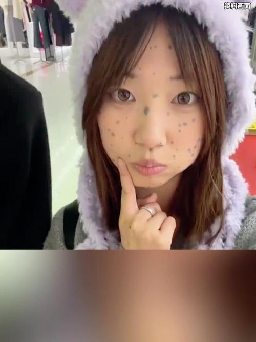 产检正常却长兽皮痣,产检正常却长兽皮痣怎么回事