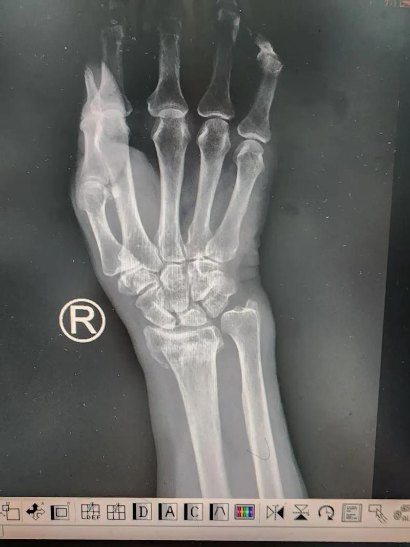 扳手腕致手臂骨折,扳手腕致手臂骨折算轻伤吗