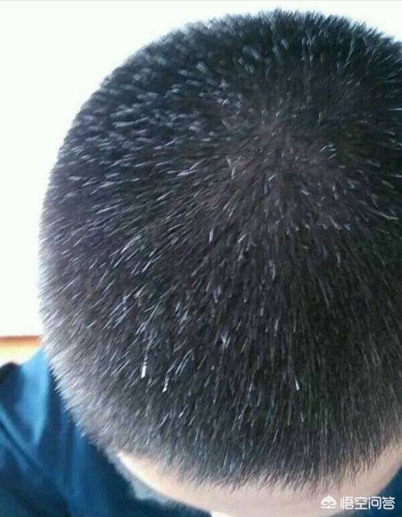 白发是身体压力警告,最近工作压力比较大，感觉白头发都出来了，皮肤也没有光泽，怎么才能调节好啊？