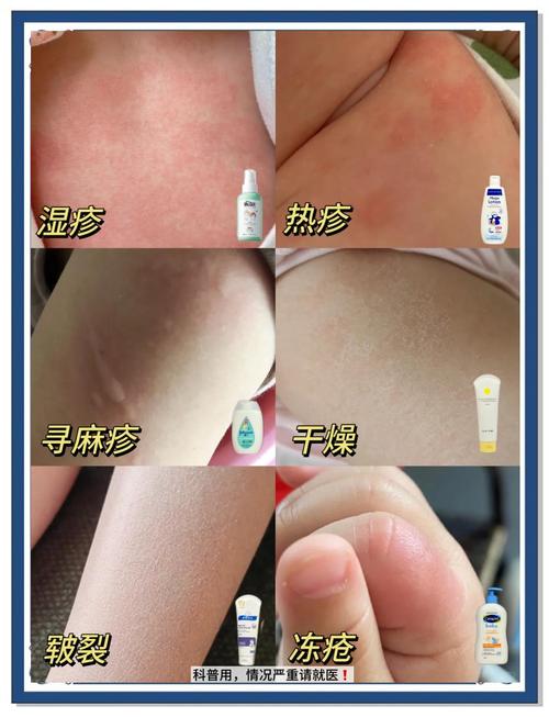 冬天洗澡可能得湿疹,宝宝天天洗澡会不会得湿疹?