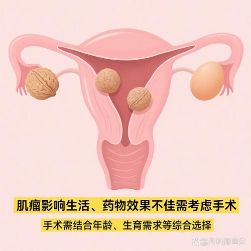 女子5年长9子宫肌瘤,50岁以后长了子宫肌瘤,还有必要做手术吗?