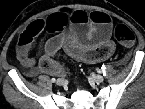 美国一男子便秘身亡,美国医生发现的奇怪新冠病毒症状-肠道异常是如何影响患者的？