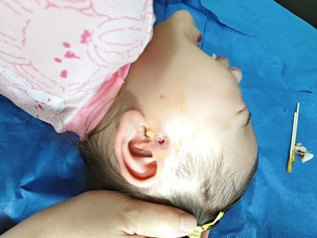 亲10月龄娃脚后嘴肿,小孩脚肿嘴肿是什么情况