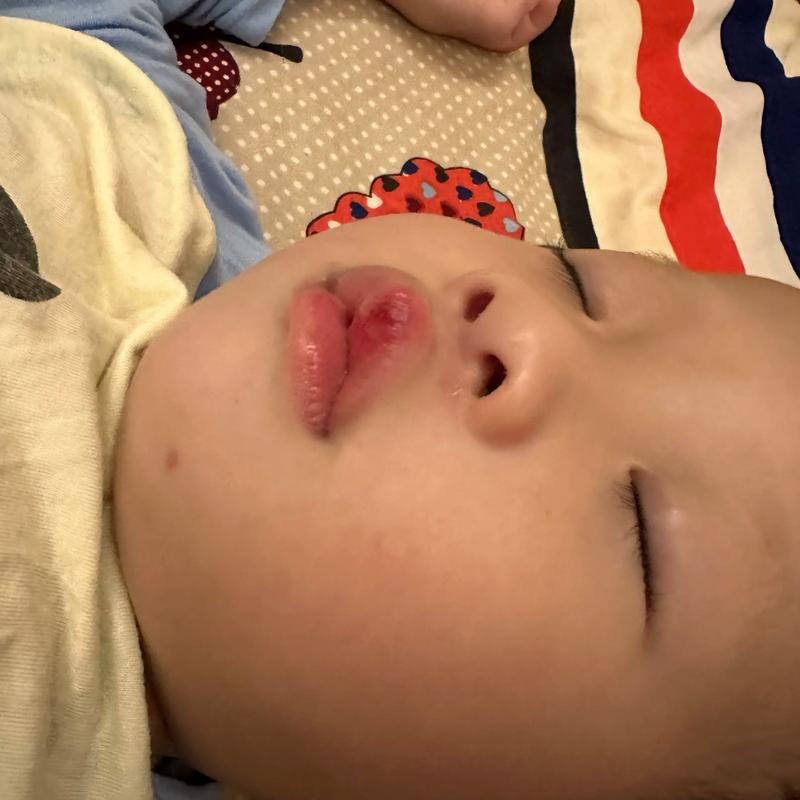 亲10月龄娃脚后嘴肿,小孩崴到脚并且肿?