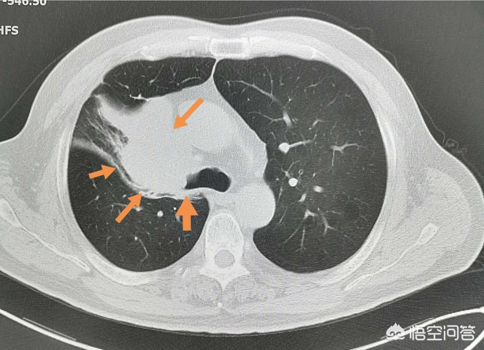 咳嗽不止查出肺癌,咳嗽老是不好会是肺癌吗? 咳嗽不止查出肺癌,咳嗽老是不好会是肺癌吗?
