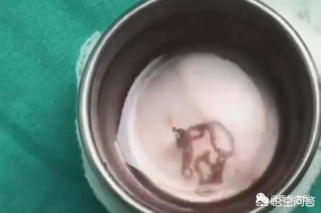 男子眼内取出7条活虫,男子眼内取出7条活虫视频