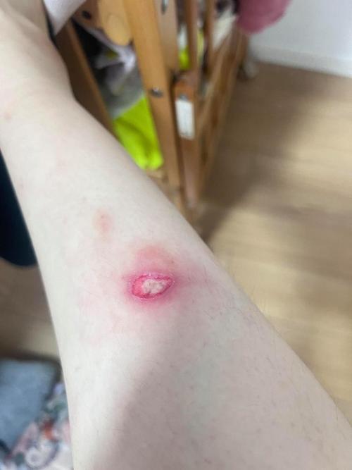 冬天低温烫伤高发季,夏天低温烫伤