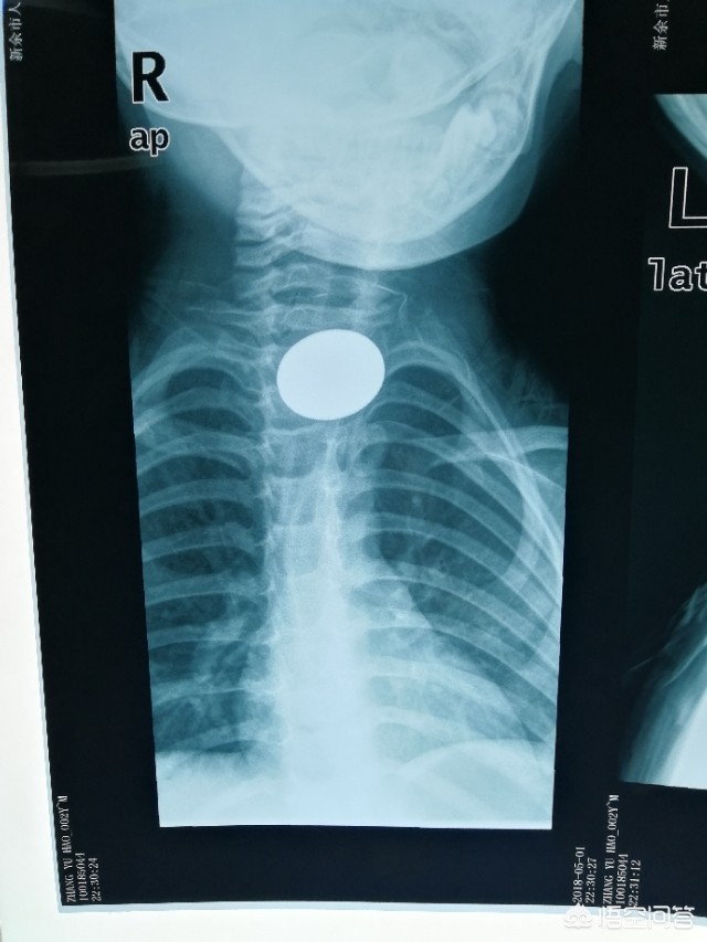 男子在按摩店内身亡,如何看待「经三次试管婴儿才出生的男婴推拿后死亡」？